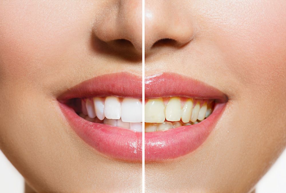 Harrisburg NC Dentist | Stained Teeth