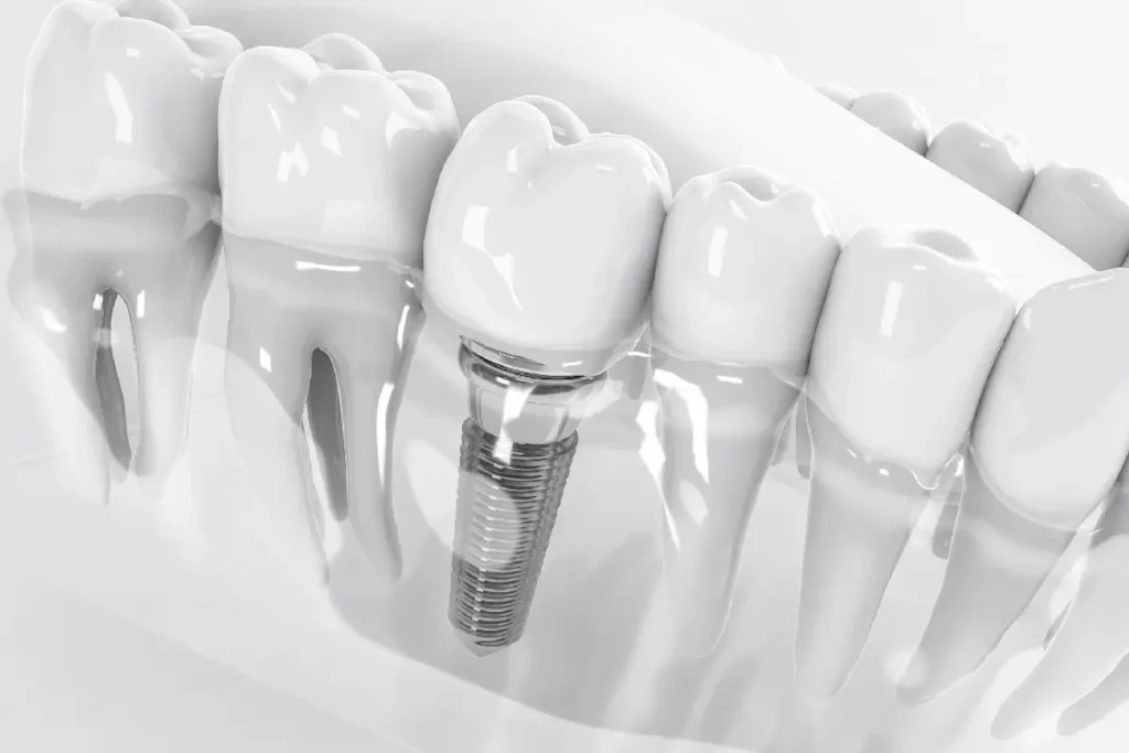 Dental Implants in Harrisburg, NC Mint Dental