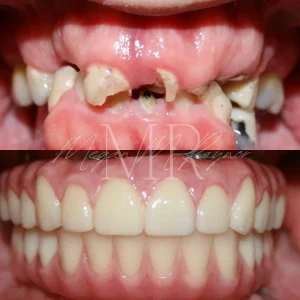 teeth-before & after