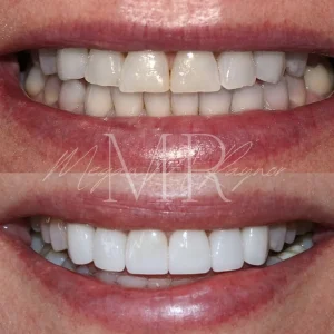 teeth-before & after