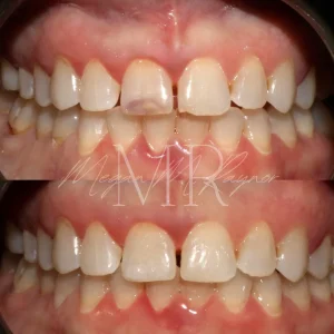 teeth-decay--before & after