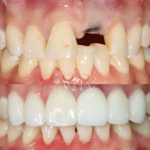 teeth-replace-before & after