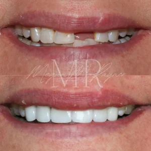 teeth-replacement-before-after