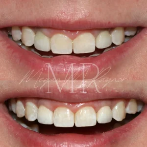 teeth-whitning-before & after